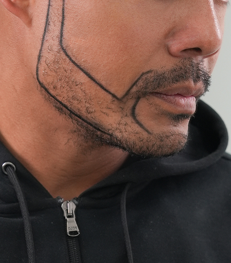 Beard & Mustache Transplant