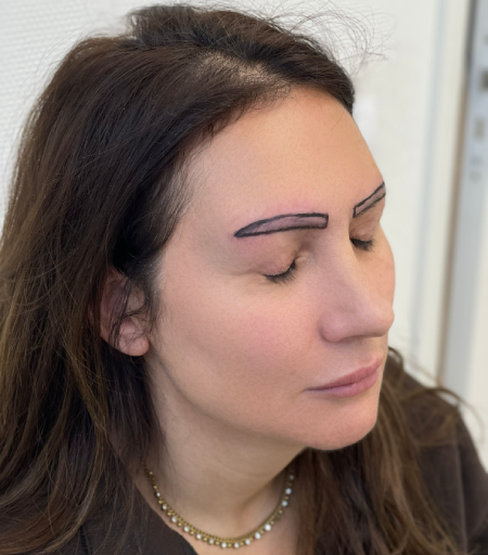 Eyebrow Transplant