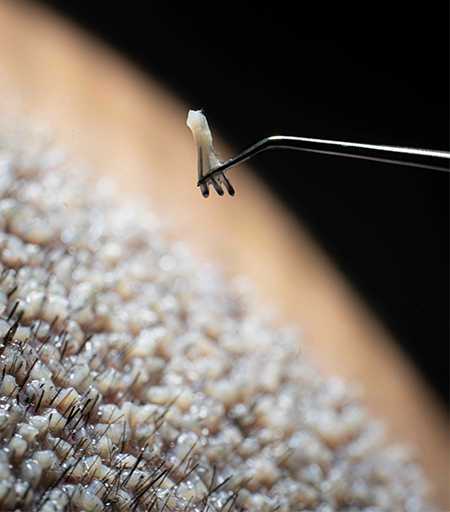 FUE Transplant